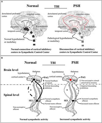 Identification and Management of Paroxysmal Sympathetic Hyperactivity After Traumatic Brain Injury